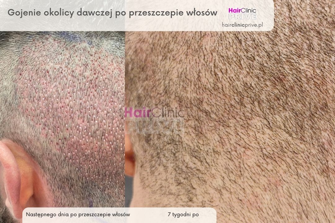 Bez tytułu (1000×1100 px) (1080×720 px) (3) gojenie okolicy dawcy , po przeszczepie włosów metoda FUE w Gdańsku w HairClinicPrive.pl