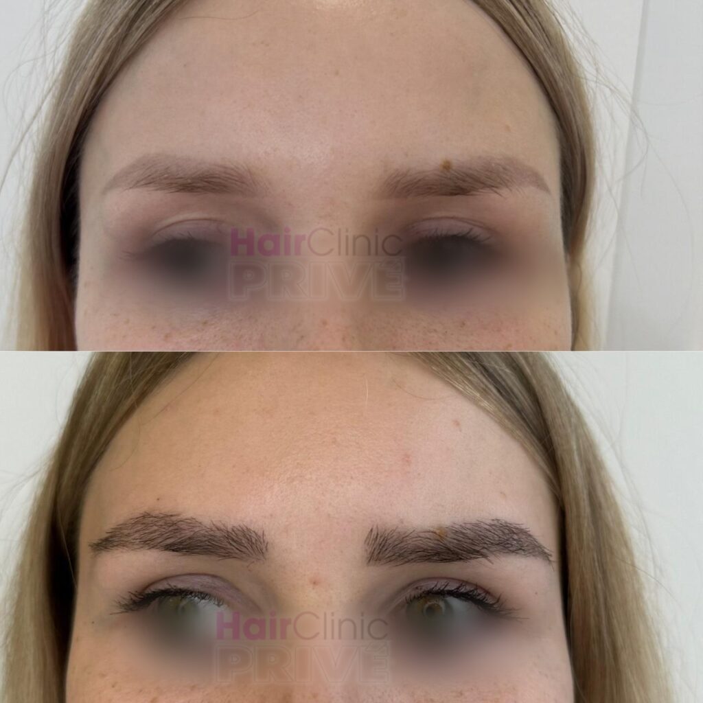 Naturalny przeszczep brwi w Hair Clinic PRIVE wykonany metodą FUE