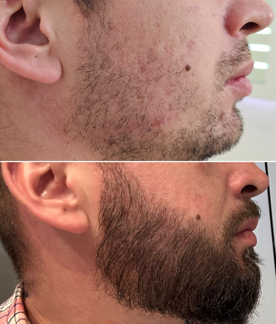 Naturalny przeszczep brody wykonany metodą FUE w Hair Clinic Prive