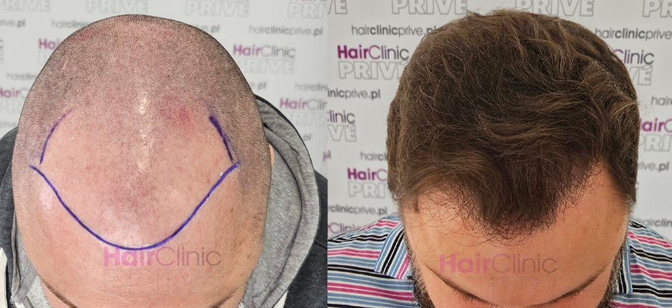 Efekty przeszczepu włosów metodą FUE DHI w Hair Clinic Prive