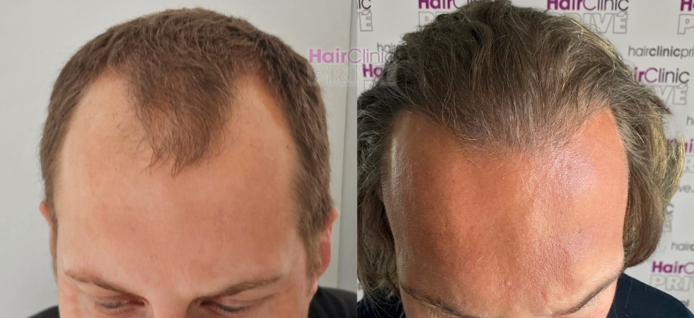 Przeszczep włosów metodą FUE DHI w Hair Clinic Prive