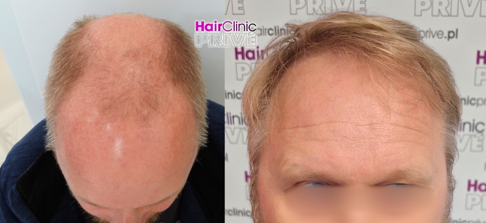 Efekty przeszczepu włosów metodą FUE DHI w Hair Clinic Prive