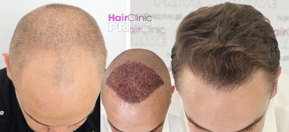 Przeszczep włosów metodą FUE DHI w Hair Clinic Prive