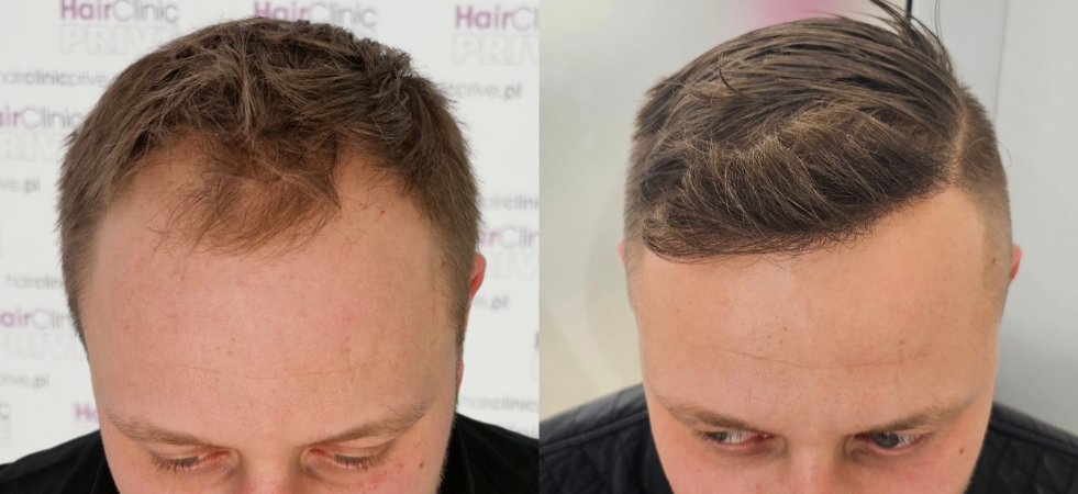 Efekty przeszczepu włosów metodą FUE DHI w Hair Clinic Prive