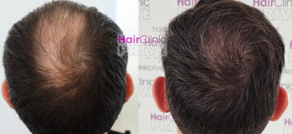Przeszczep włosów metodą FUE DHI w Hair Clinic Prive