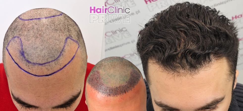 Przeszczep włosów metodą FUE DHI w Hair Clinic Prive