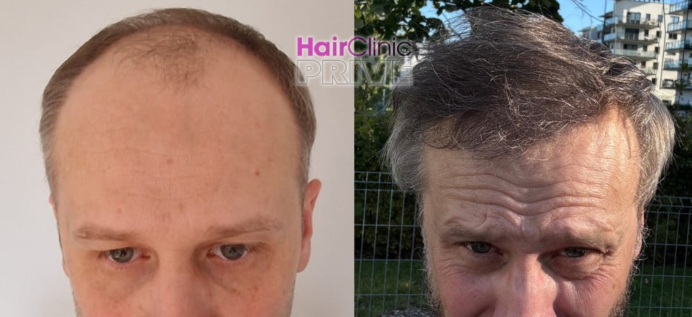 Przeszczep włosów metodą FUE DHI w Hair Clinic Prive