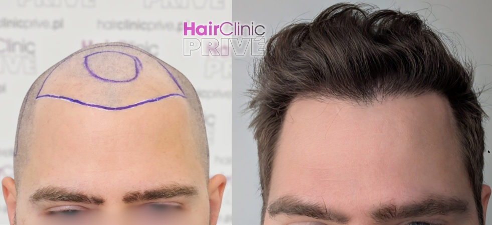 Efekty przeszczepu włosów metodą FUE DHI w Hair Clinic Prive