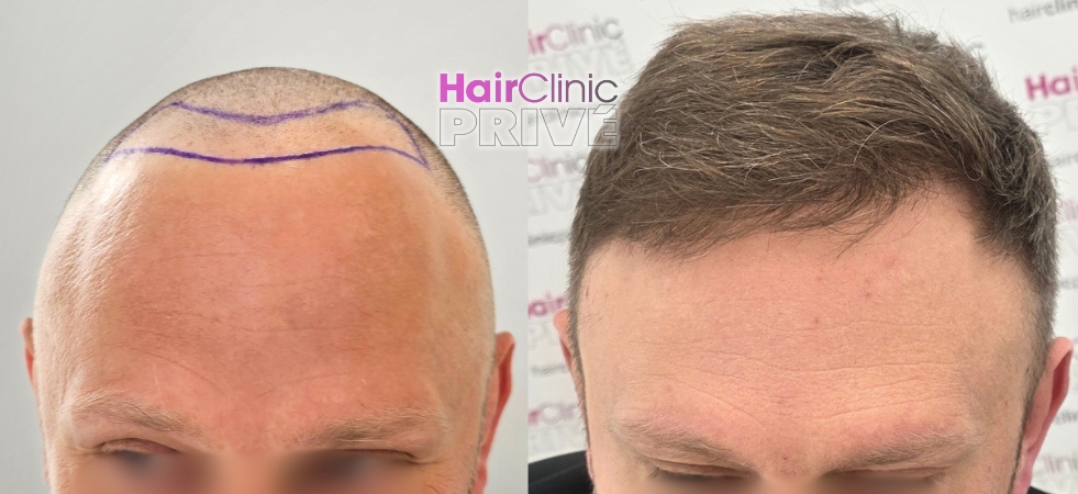 Efekty przeszczepu włosów metodą FUE DHI w Hair Clinic Prive