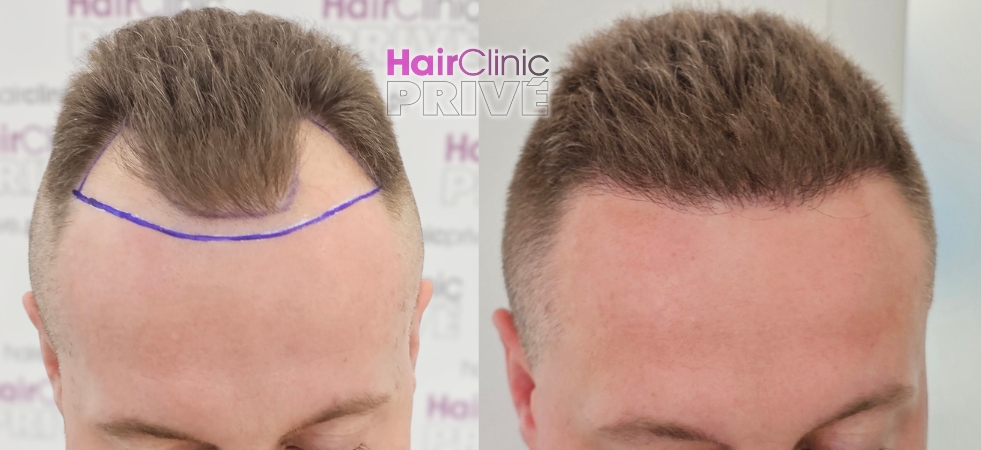 Przeszczep włosów metodą FUE DHI w Hair Clinic Prive