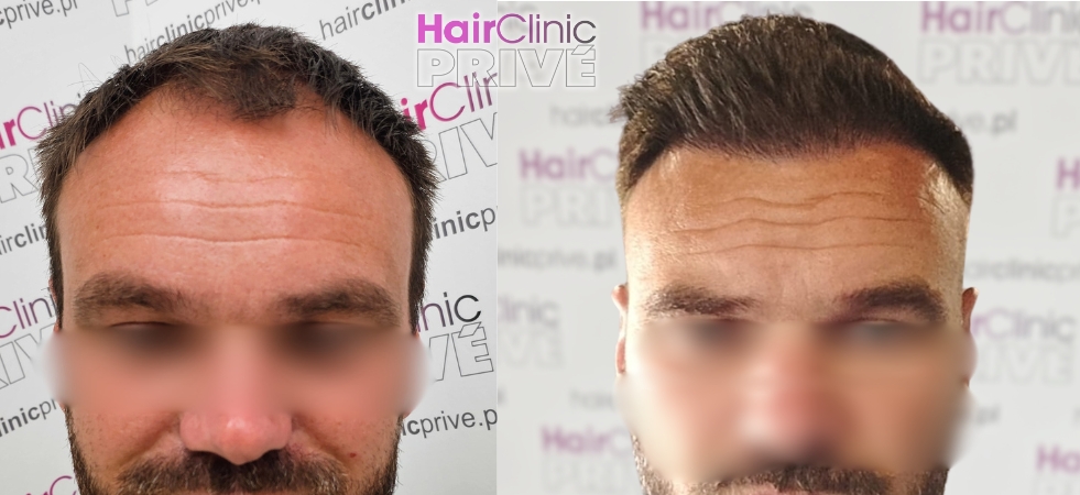 Przeszczep włosów metodą FUE DHI w Hair Clinic Prive