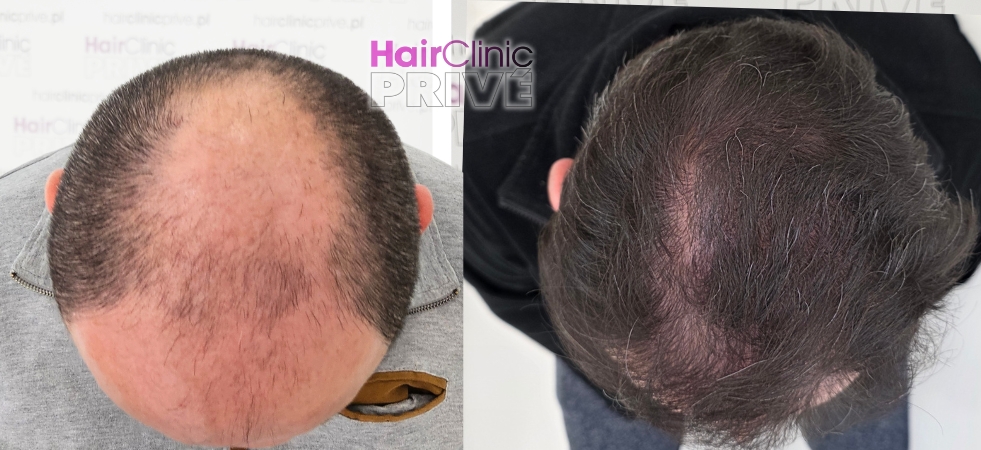 Przeszczep włosów metodą FUE DHI w Hair Clinic Prive