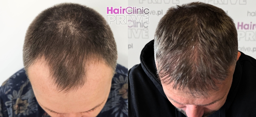 Efekty przeszczepu włosów metodą FUE DHI w Hair Clinic Prive