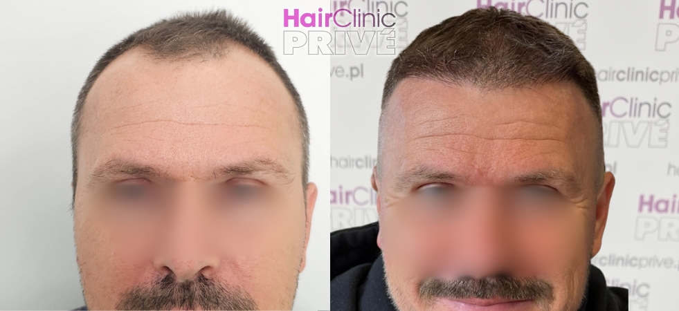 Przeszczep włosów metodą FUE DHI w Hair Clinic Prive