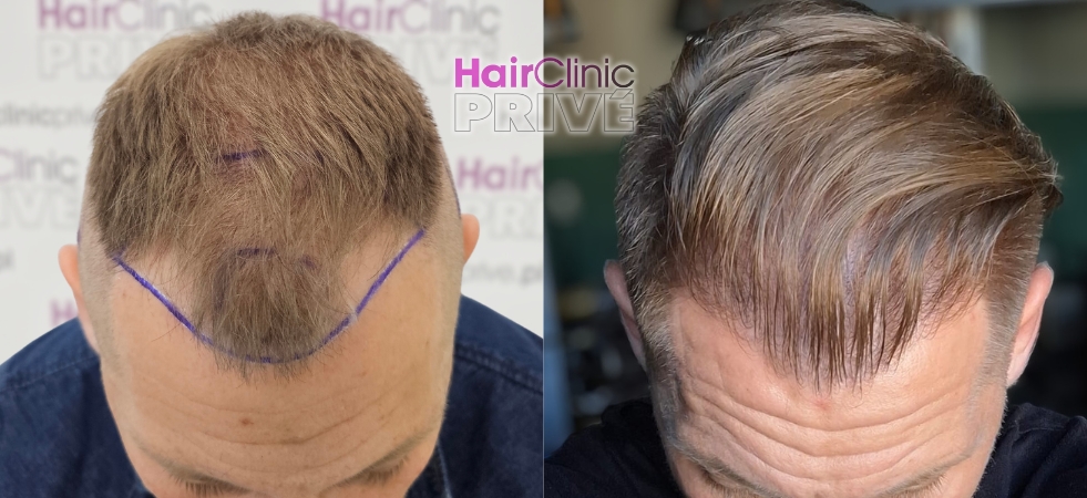 Efekty przeszczepu włosów metodą FUE DHI w Hair Clinic Prive