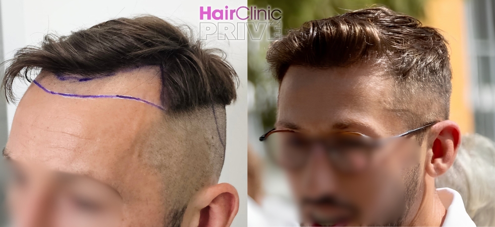 Przeszczep włosów metodą FUE DHI w Hair Clinic Prive