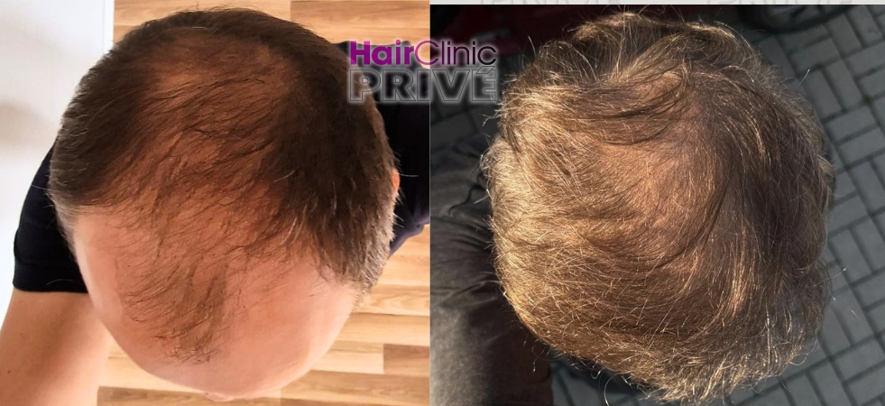 Efekty przeszczepu włosów metodą FUE DHI w Hair Clinic Prive