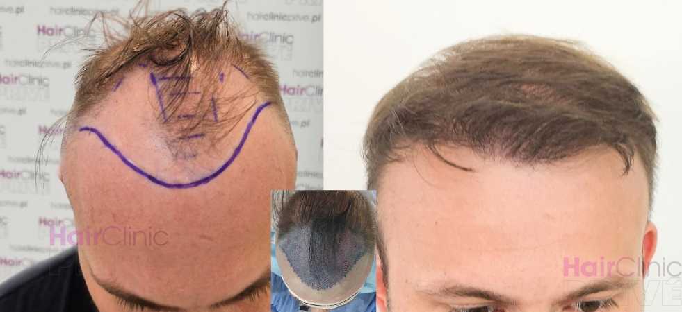 Implantacja włosów metodą DHI podczas zabiegu FUE