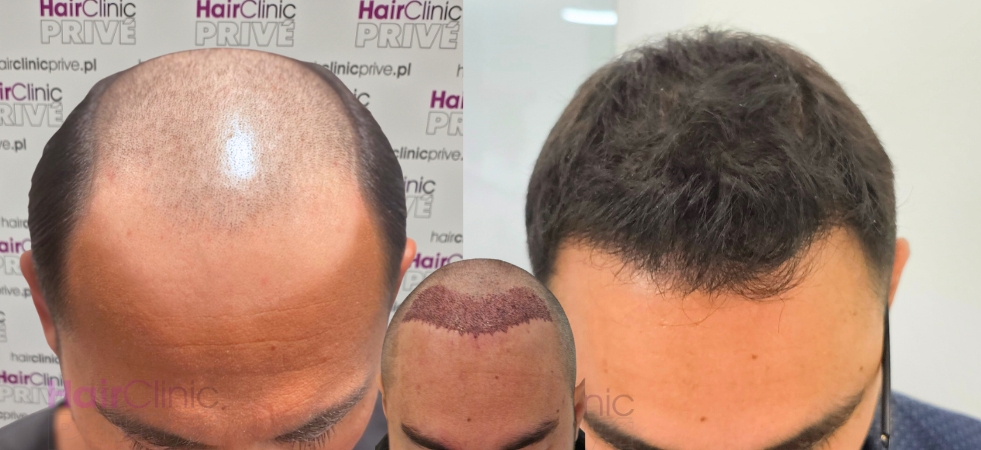 Efekty przeszczepu włosów metodą FUE DHI w Hair Clinic Prive
