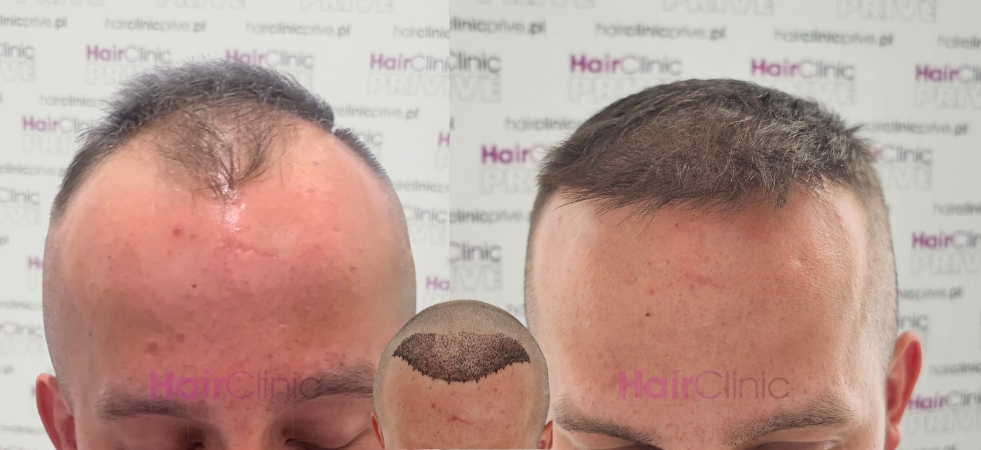 Przeszczep włosów metodą FUE DHI w Hair Clinic Prive