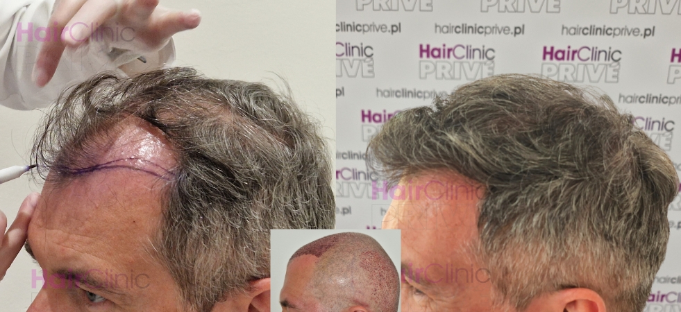 Efekty przeszczepu włosów metodą FUE DHI w Hair Clinic Prive