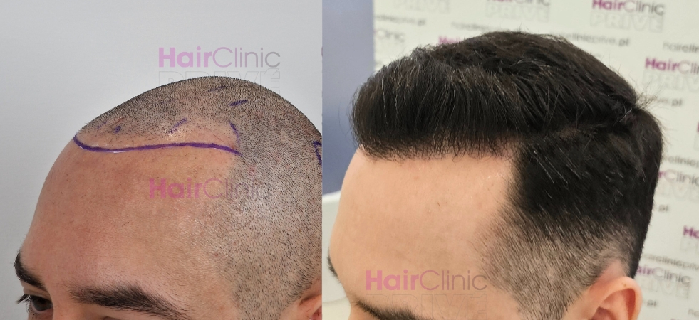 Przeszczep włosów metodą FUE DHI w Hair Clinic Prive