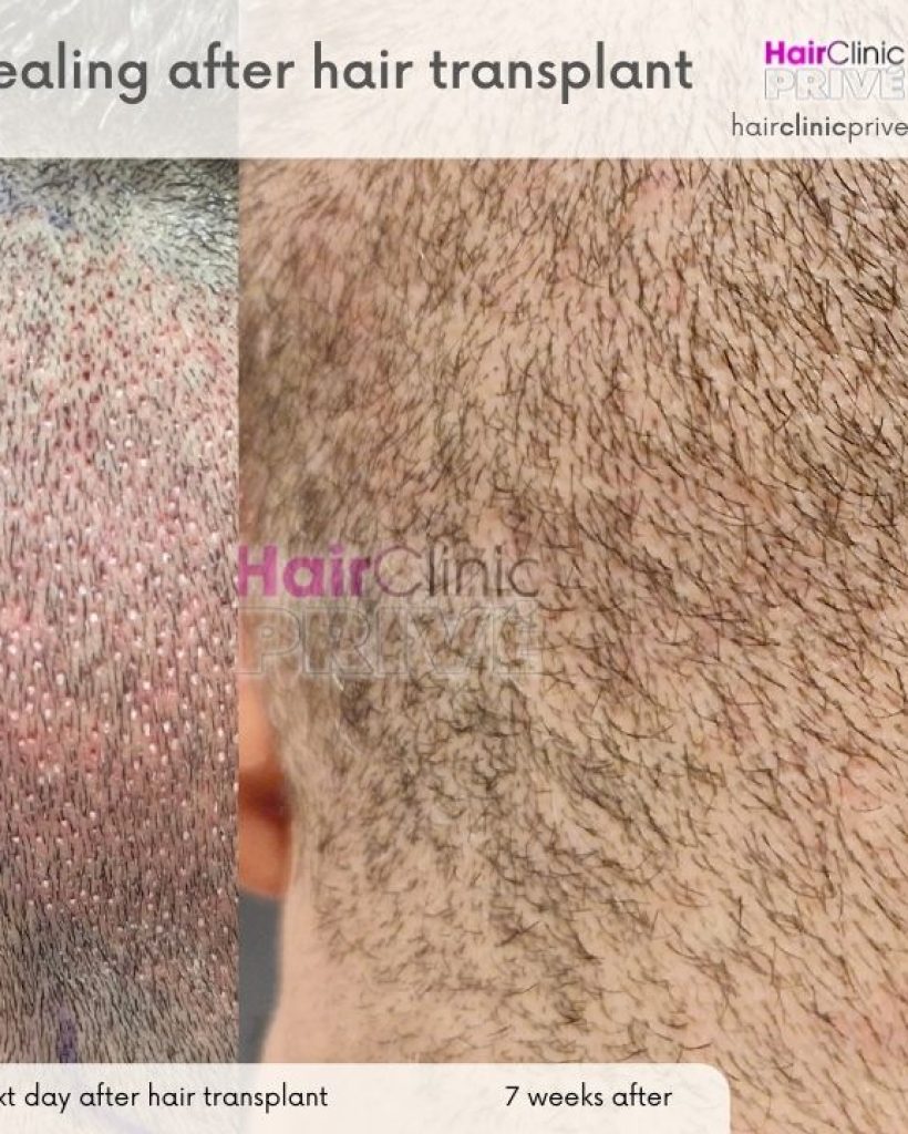 before and after hair transplant FUE donor area