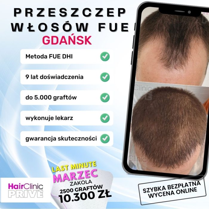 PRZESZCZEP WŁOSÓW FUE (11)